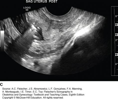 guided procedures using transvaginal transabdominal and transrectal sonography obgyn key