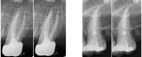 Molars Anatomy Pt1 Upper Second Molar Style Italiano Endodontics