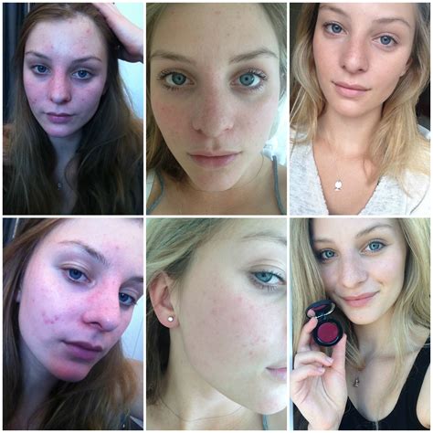 How I Cured My Cystic Acne Rosacea The Pure Life