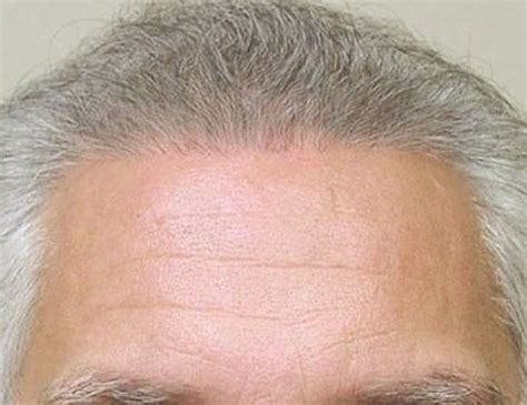 Patient 133066253 Hair Transplant Smartgraft Before And After Photos