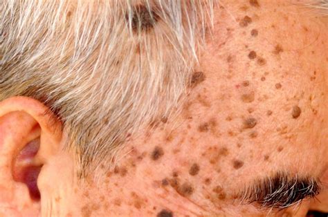 What Is Seborrheic Keratosis And Can It Be Removed