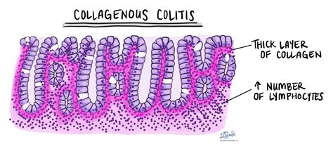 Microscopic Colitis Mypathologyreportca