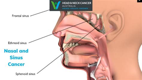 Nasal And Sinus Cancer What Is It What Are The Symptoms And Treatment Head And Neck Cancer
