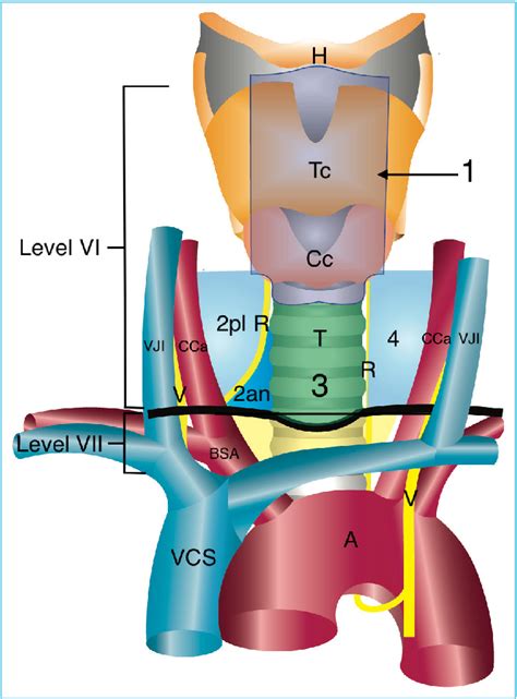 Figure 2 From Role And Extent Of Neck Dissection For Neck Lymph Node