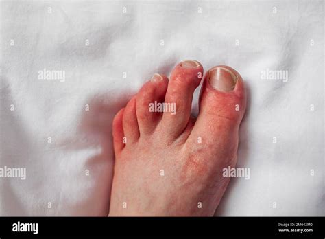 Chilblains On Toes Red Itchy Bumps Swelling Foot Of Person With