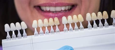 4 Things You Need To Know Before Getting Porcelain Veneers One Fine