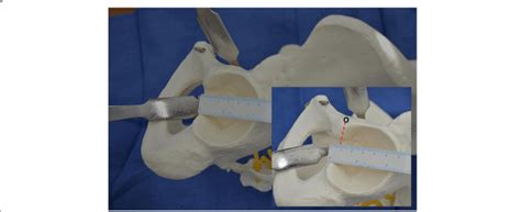 Anterior Acetabular Retractor In The 9 Oclock Position Of The Left Hip
