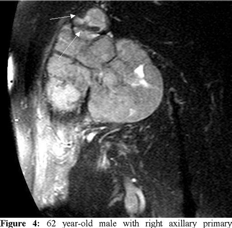 Figure 1 From Primary Dedifferentiated Liposarcoma Of The Axilla