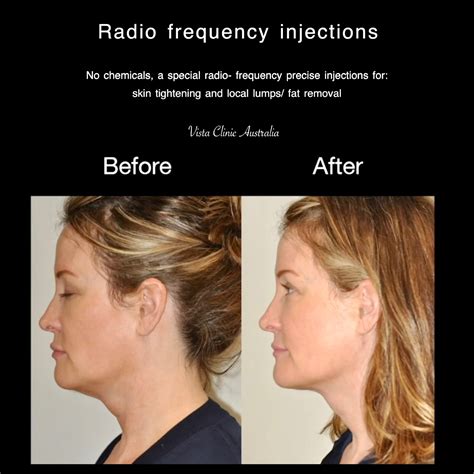 Radiofrequency Injections Vista Clinic Melbourne