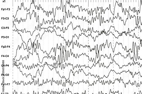 Brain Wave Patterns On Electroencephalogram Eeg Of The Pediatric