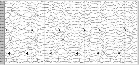 Bilateral Independent Periodic Lateralised Epileptiform Discharges At
