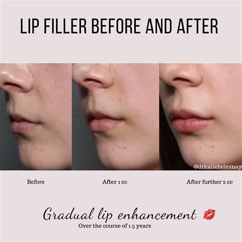 Lip Filler And Gradual Lip Enhancement — Dr Katie Beleznay