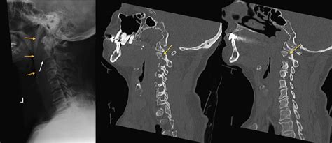 C2 Fracture Xr And Ct Radiology At St Vincents University Hospital
