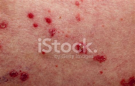 Psoriasis Stock Photo Royalty Free Freeimages