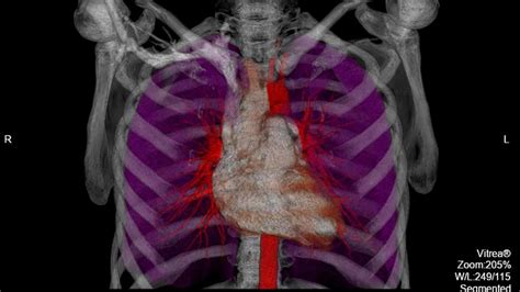 Division Of Cardiothoracic Imaging Columbia Radiology Columbia