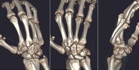 Cureus Isolated Dorsal Dislocations Of The Fourth And Fifth