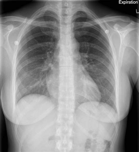 Pneumothorax Case 5 • Litfl • Ultrasound Library Clinical Case