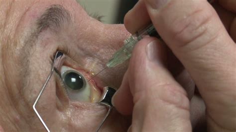 Eyeball Injections Equal Eye Popping Profits Video Investing