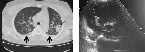 Left Day 1 The Chest Ct Scan Showed A Wedge Shaped Consolidation In