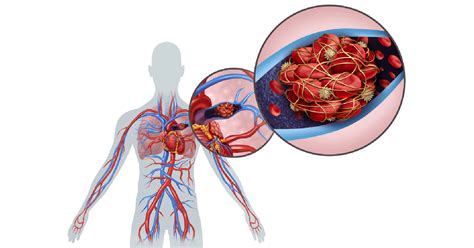 Blood Clots Symptoms Causes Prevention And Treatments