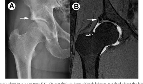Imaging Of Femoral Acetabular Impingement Syndrome St Vrogue Co