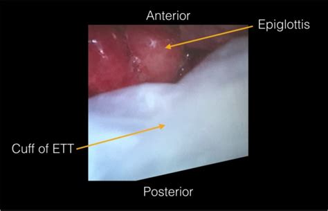 Adult Epiglottitis A Case Series The Permanente Journal