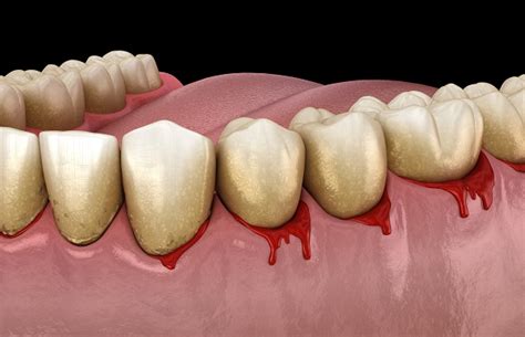 common signs of gum disease