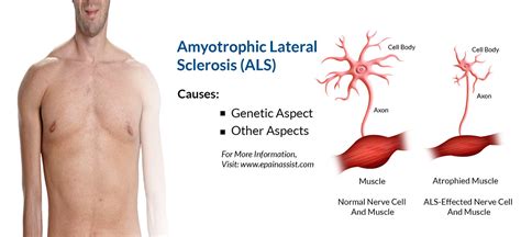 Amyotrophic Lateral Sclerosis Als Or Lou Gehrigs Diseasesymptoms