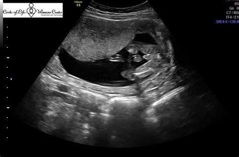 What Do 16 Week Baby Boy Ultrasounds Look Like Babycenter