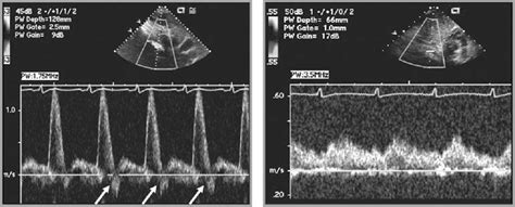 Abdominal Aortic Pulsed Wave Doppler Patterns Reliably Reflect Clinical