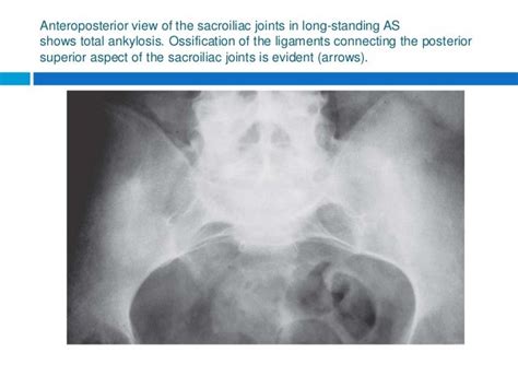 Ankylosing Spondylitis Sacroiliac Joints