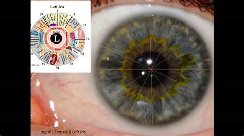 Iridology Review Lymph Trapped Under Skin With Some Lymph Node Swelling