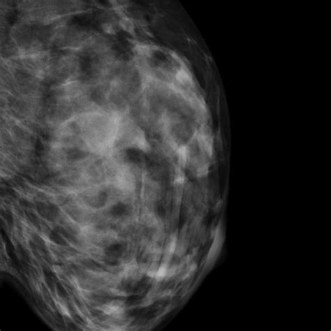 Mlo Mammogram Left Breast Demonstrates Linear Parallel Vascular