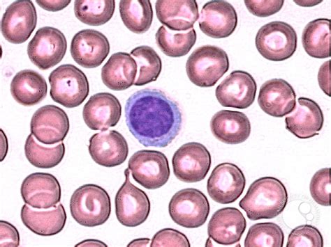 Plasmacytoid Lymphocyte 1