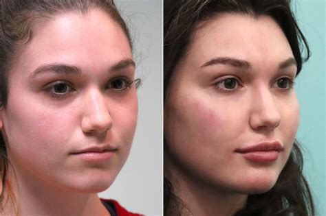 Cheeks Midface Injections Injections Laser Treatments Photos