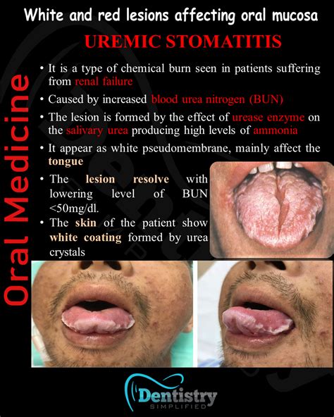 Uremic Stomatitis White And Red Lesions 12 Dentistrty