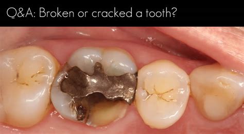 Broken Tooth Or Cracked Teeth Windsor Dentists
