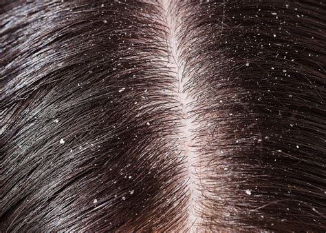 The microbiology of a superficial disorder-Dandruff - PENzIT