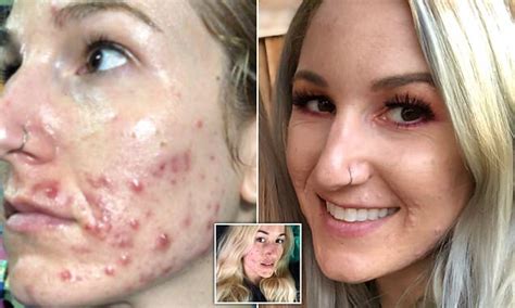 Woman Who Developed Cystic Acne At Age Becomes Skin Positivity Activist Daily Mail Online