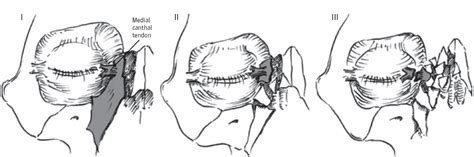 Frontal Sinus and Naso-orbital-Ethmoid Fractures | Facial ...