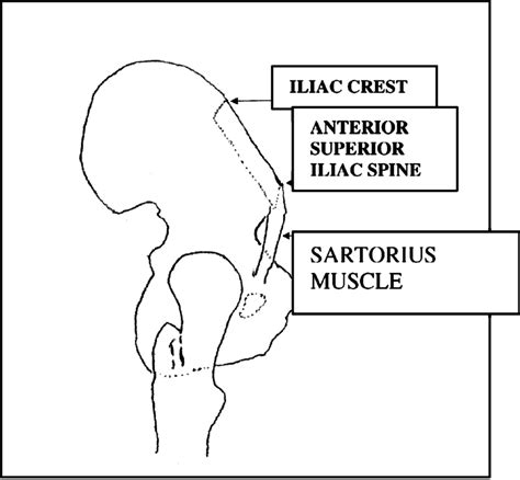 Iliac Crest Resection Site Down To The Anterior Superior Iliac Spine