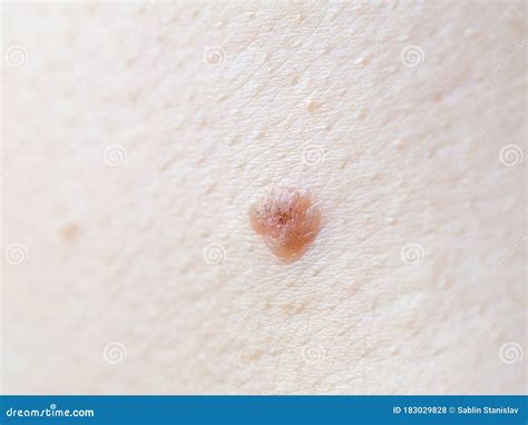 Melanoma On Human Skin Close Up Stock Photo Image Of Disease