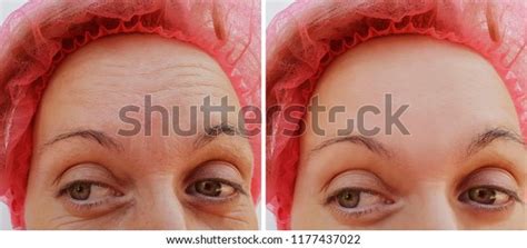 Forehead Woman Wrinkles Before After Cosmetic Stock Photo 1177437022
