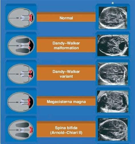 Brain Structures Ultrasound School Baby Ultrasound Sonogram