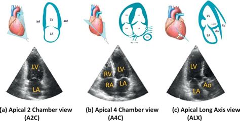 Echocardiographic Apical Views A Apical 2 Chamber View A2c B