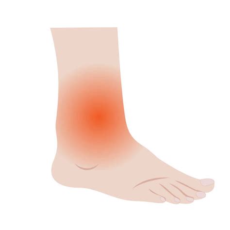 Symptoms Of Sprained Ankle Illustrations Royalty Free Vector Graphics