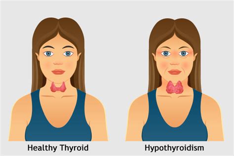 How To Identify Hypothyroidism And Treat It Emedihealth