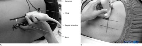 Regional Anesthesia Position Of Patient And Us Transducer During