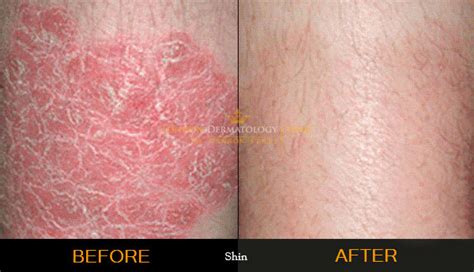 Psoriasis Treatment £195 London Dermatology Clinic