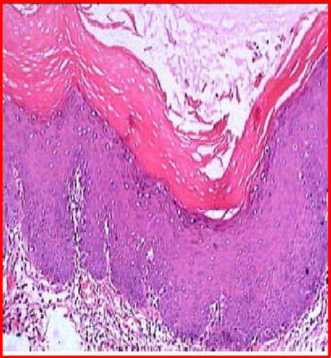 Figure 8 From Management Of Proliferative Verrucous Leukoplakia By